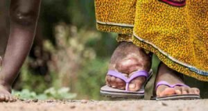 नवापुर तालुक्यात हत्तीरोग नियंत्रणासाठी औषधोपचार मोहिम सुरु elephantisis disease Navapur