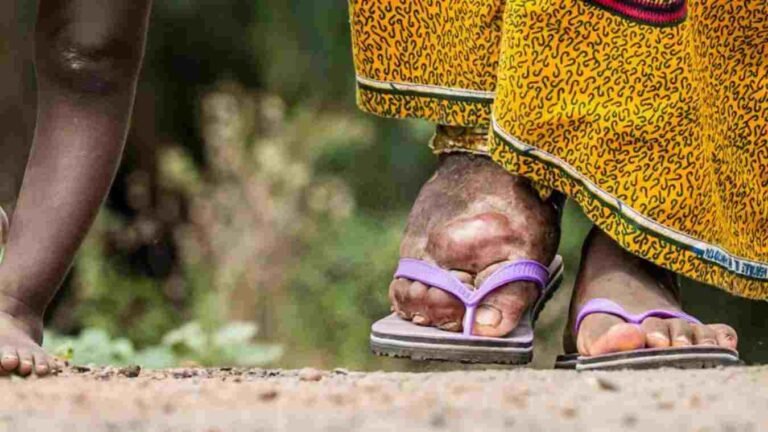नवापुर तालुक्यात हत्तीरोग नियंत्रणासाठी औषधोपचार मोहिम सुरु